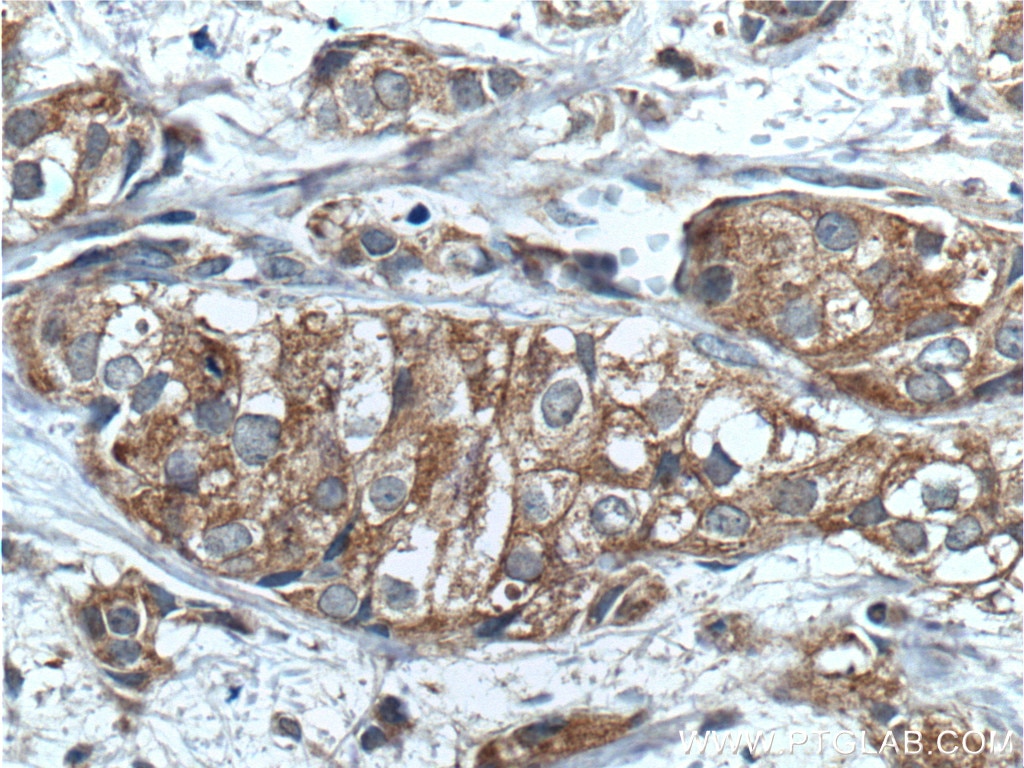 Immunohistochemistry (IHC) staining of human breast cancer tissue using PRG2 Polyclonal antibody (10766-1-AP)