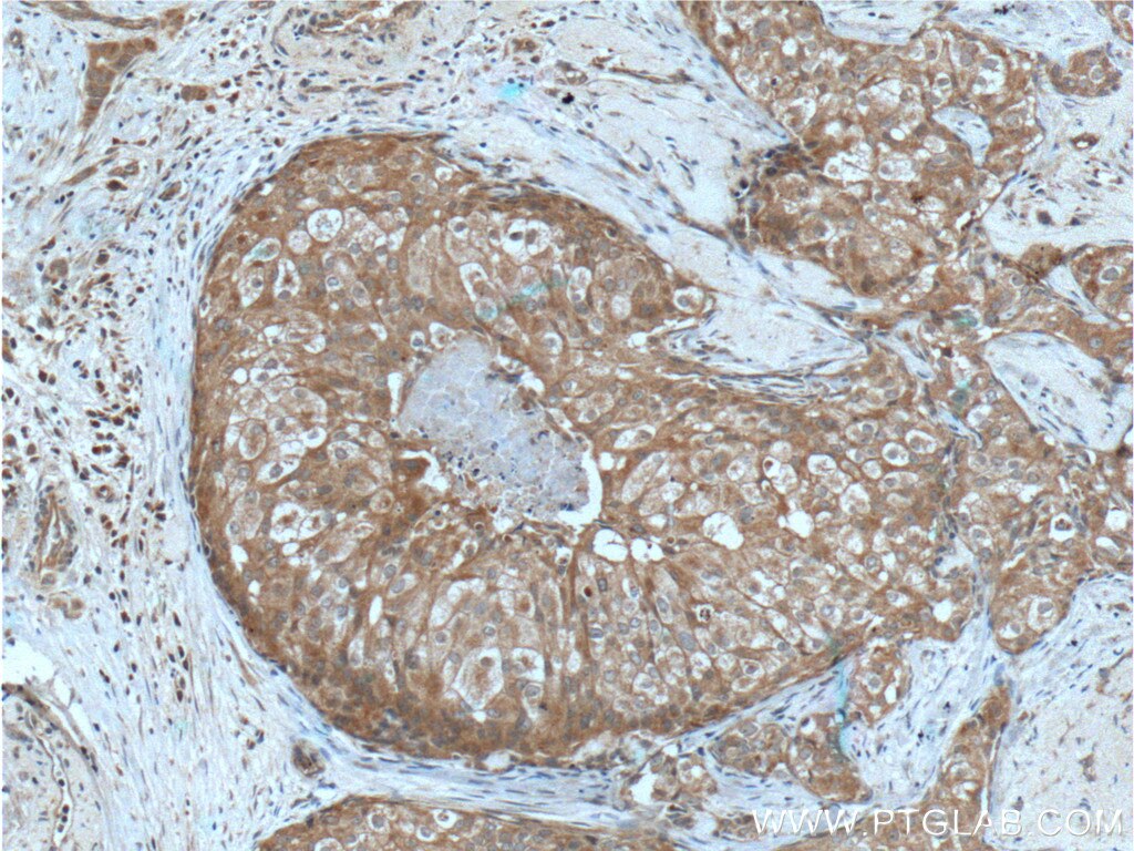 IHC staining of human breast cancer using 10766-1-AP