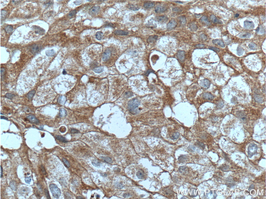 Immunohistochemistry (IHC) staining of human breast cancer tissue using PRG2 Polyclonal antibody (10766-1-AP)