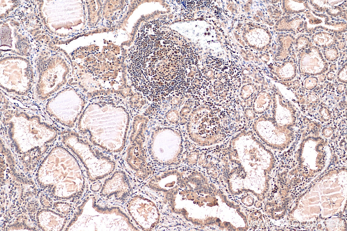 Immunohistochemistry (IHC) staining of human thyroid cancer tissue using PRIM1 Polyclonal antibody (10773-1-AP)