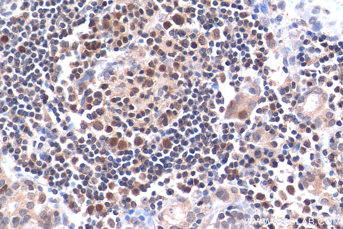 Immunohistochemistry (IHC) staining of human thyroid cancer tissue using PRIM1 Polyclonal antibody (10773-1-AP)