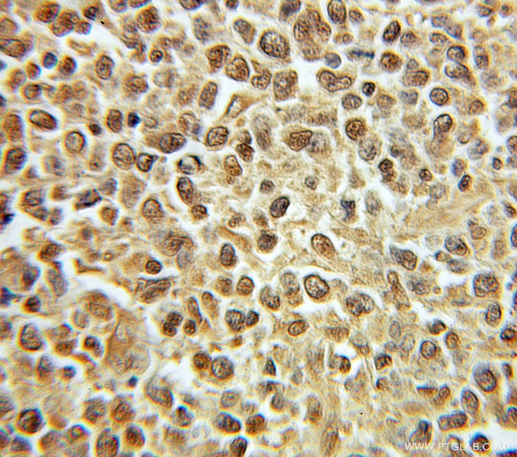 IHC staining of human lymphoma using 10773-1-AP
