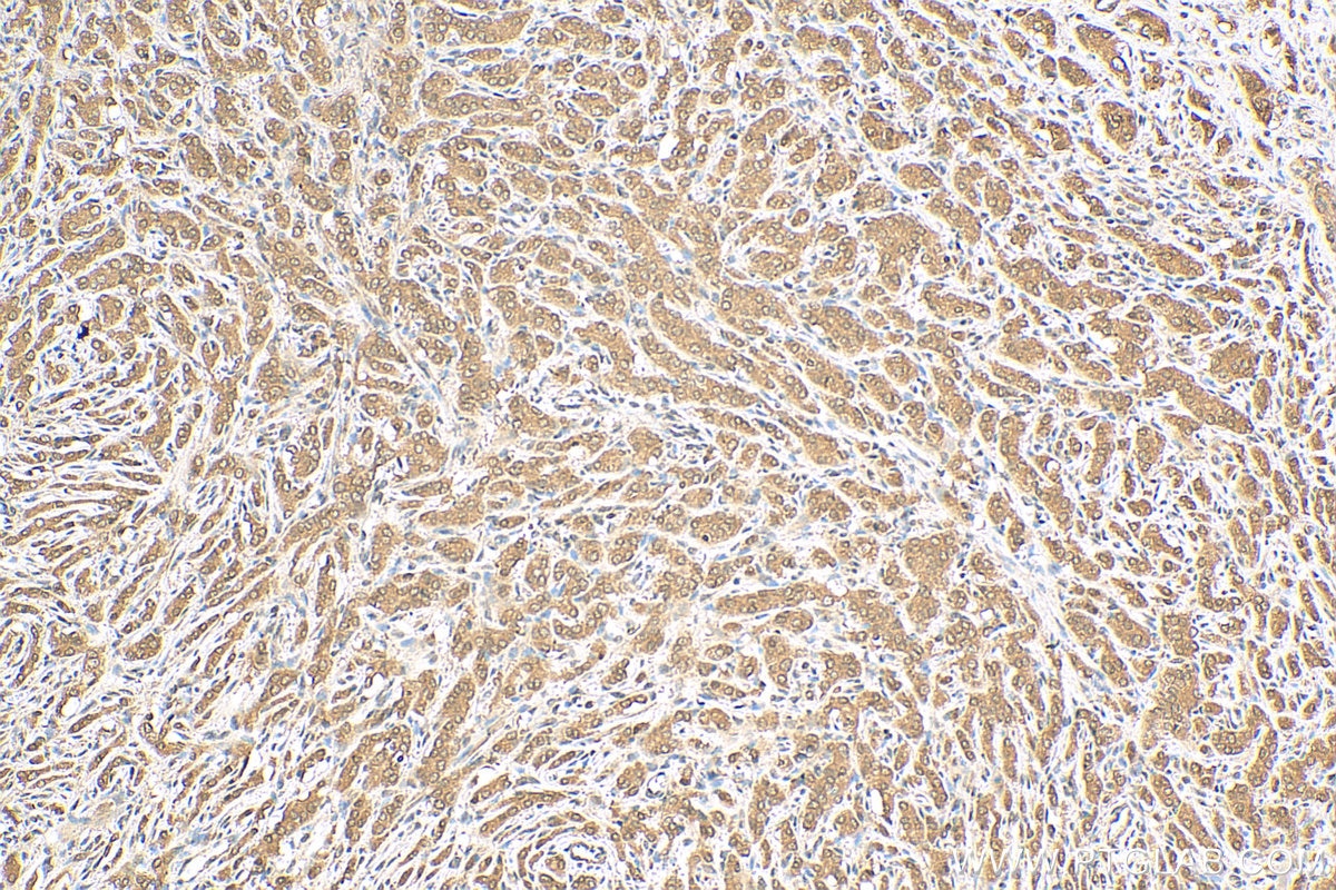 Immunohistochemistry (IHC) staining of human prostate cancer tissue using AMPK Alpha 1 Polyclonal antibody (10929-2-AP)
