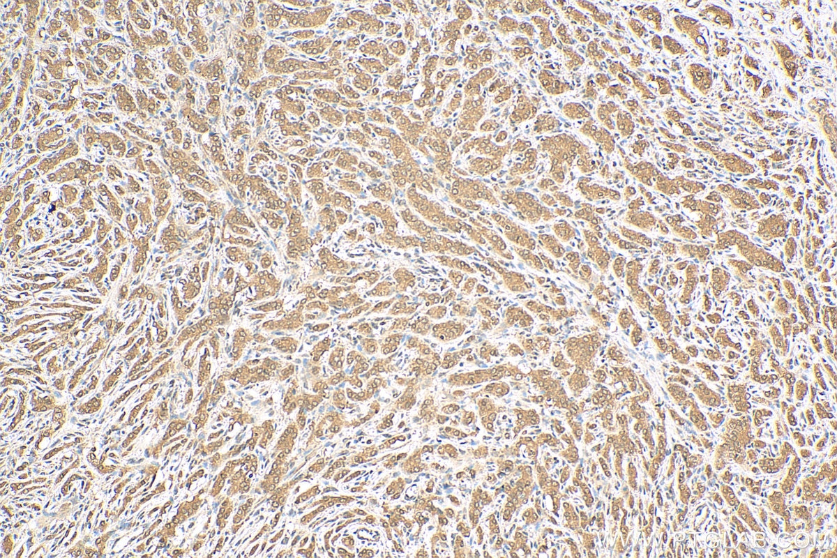 Immunohistochemistry (IHC) staining of human prostate cancer tissue using AMPK Alpha Polyclonal antibody (10929-2-AP)