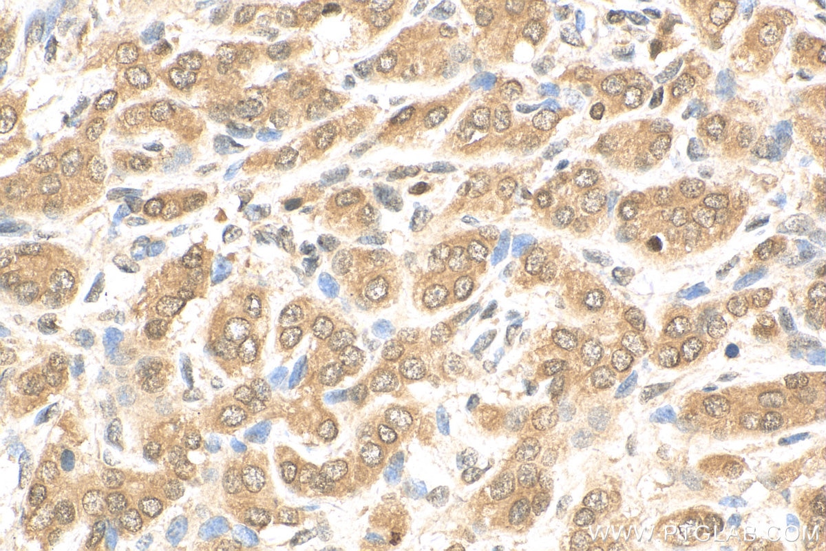 Immunohistochemistry (IHC) staining of human prostate cancer tissue using AMPK Alpha Polyclonal antibody (10929-2-AP)