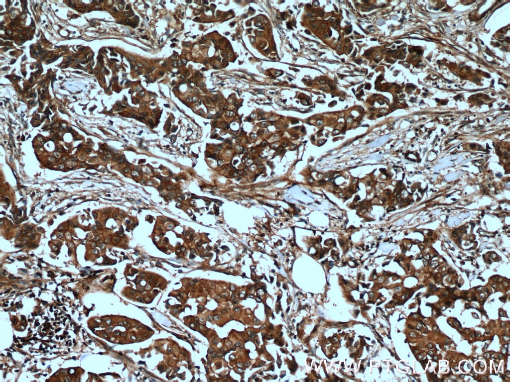 Immunohistochemistry (IHC) staining of human breast cancer tissue using AMPK Alpha 2 Polyclonal antibody (18167-1-AP)