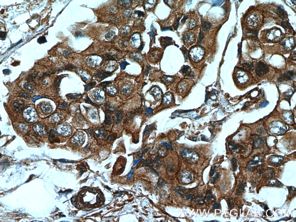 Immunohistochemistry (IHC) staining of human breast cancer tissue using AMPK Alpha 2 Polyclonal antibody (18167-1-AP)