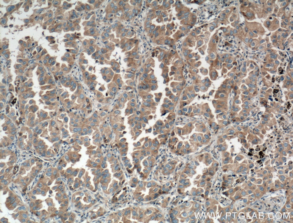 Immunohistochemistry (IHC) staining of human lung cancer tissue using AMPK Beta 1 Polyclonal antibody (10308-1-AP)