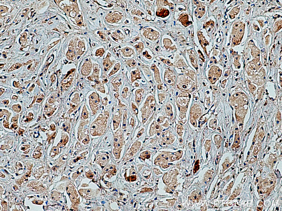 Immunohistochemistry (IHC) staining of human breast cancer tissue using PRKACA Polyclonal antibody (24503-1-AP)