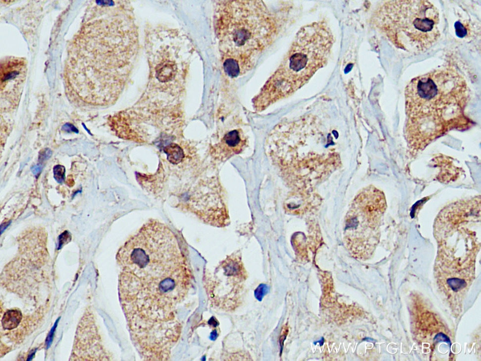 Immunohistochemistry (IHC) staining of human breast cancer tissue using PRKACA Polyclonal antibody (24503-1-AP)