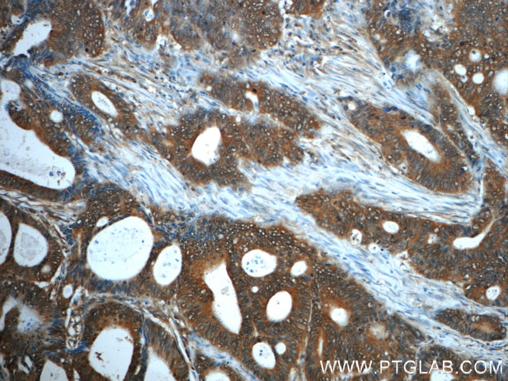 Immunohistochemistry (IHC) staining of human colon cancer tissue using PKA C-alpha specific Polyclonal antibody (55388-1-AP)