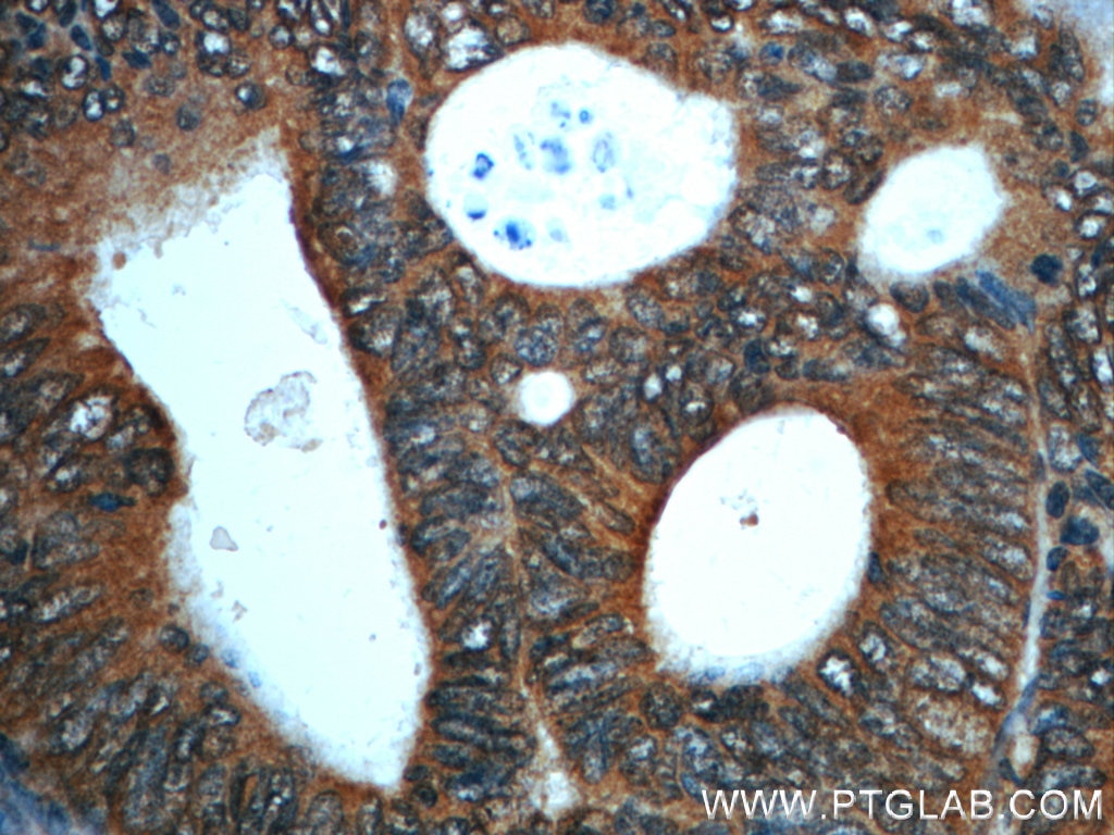 IHC staining of human colon cancer using 55388-1-AP