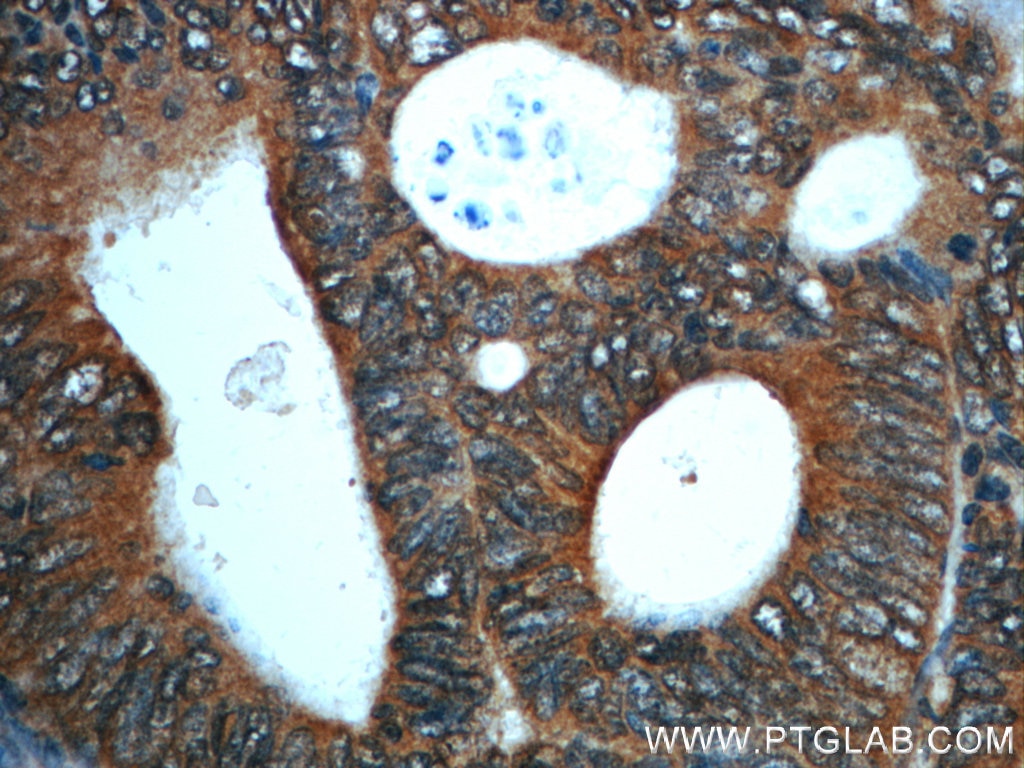 Immunohistochemistry (IHC) staining of human colon cancer tissue using PKA C-alpha specific Polyclonal antibody (55388-1-AP)