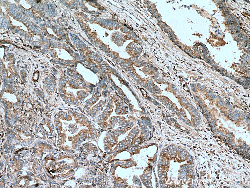 Immunohistochemistry (IHC) staining of human prostate cancer tissue using PRKACA Monoclonal antibody (67491-1-Ig)