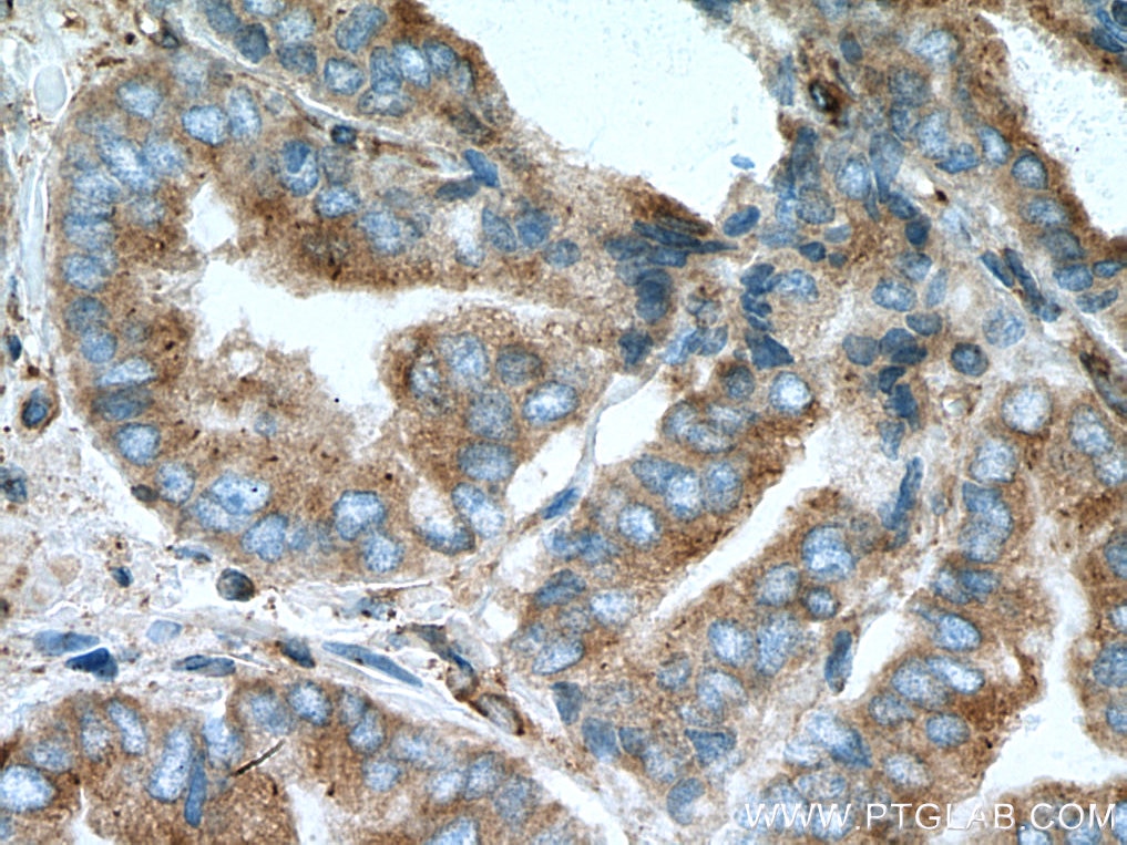 Immunohistochemistry (IHC) staining of human prostate cancer tissue using PRKACA Monoclonal antibody (67491-1-Ig)