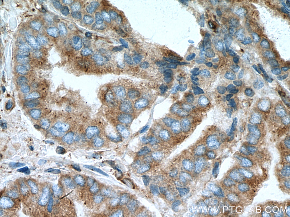 IHC staining of human prostate cancer using 67491-1-Ig