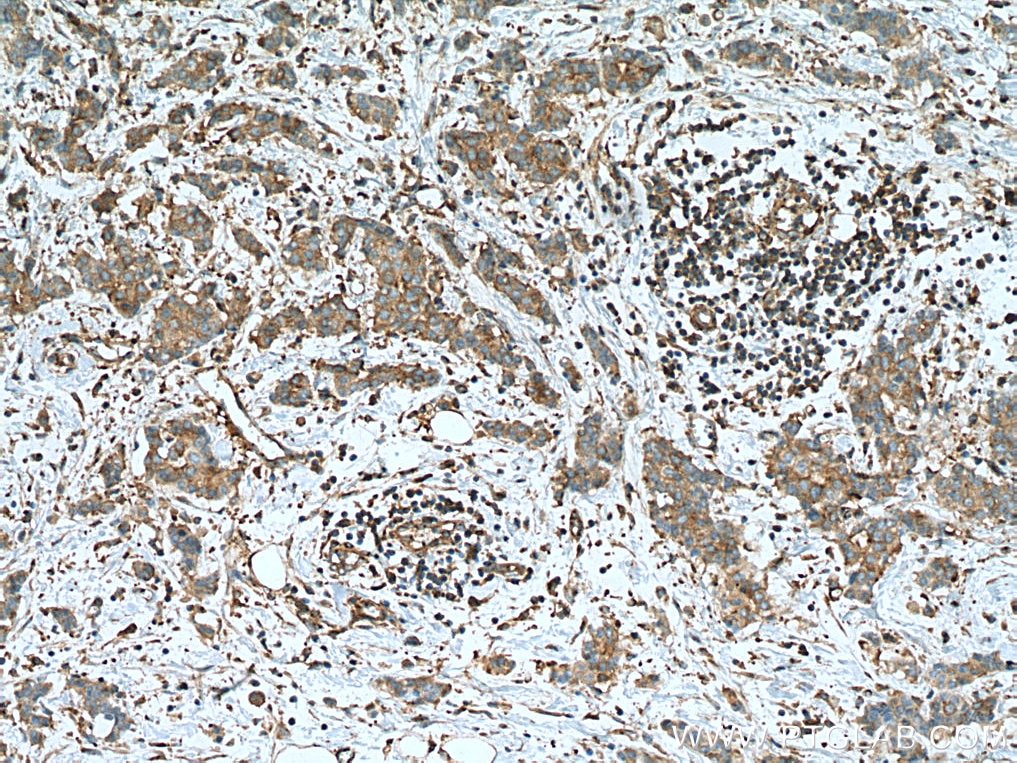 Immunohistochemistry (IHC) staining of human breast cancer tissue using PRKACA Monoclonal antibody (67491-1-Ig)