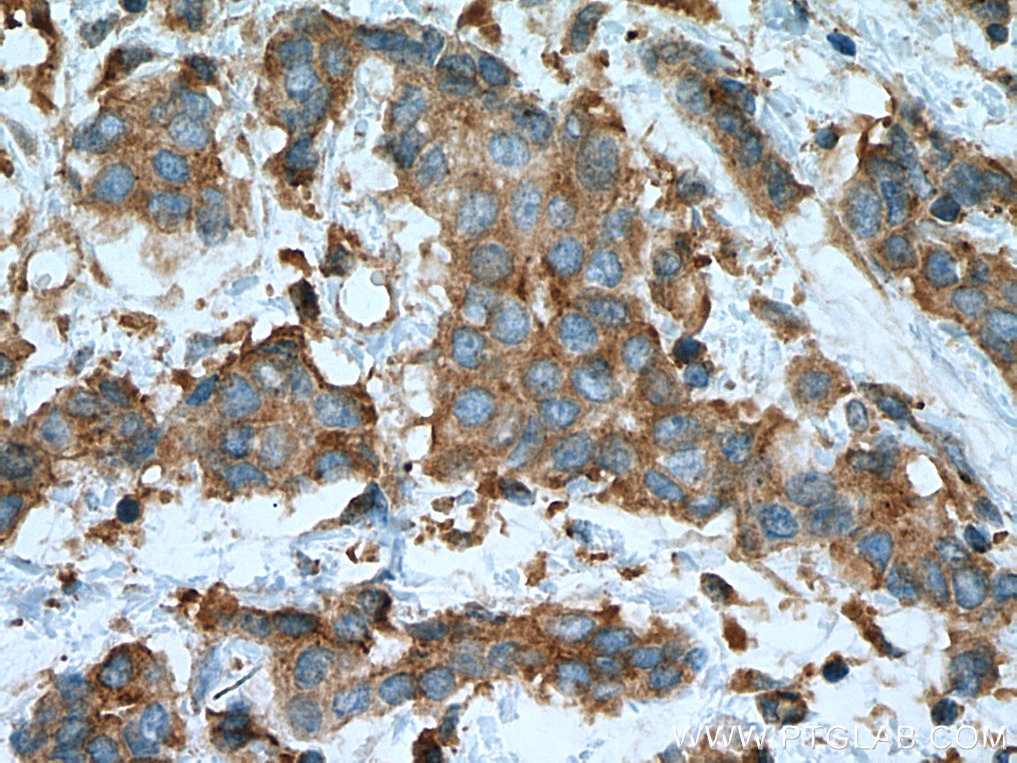 Immunohistochemistry (IHC) staining of human breast cancer tissue using PRKACA Monoclonal antibody (67491-1-Ig)