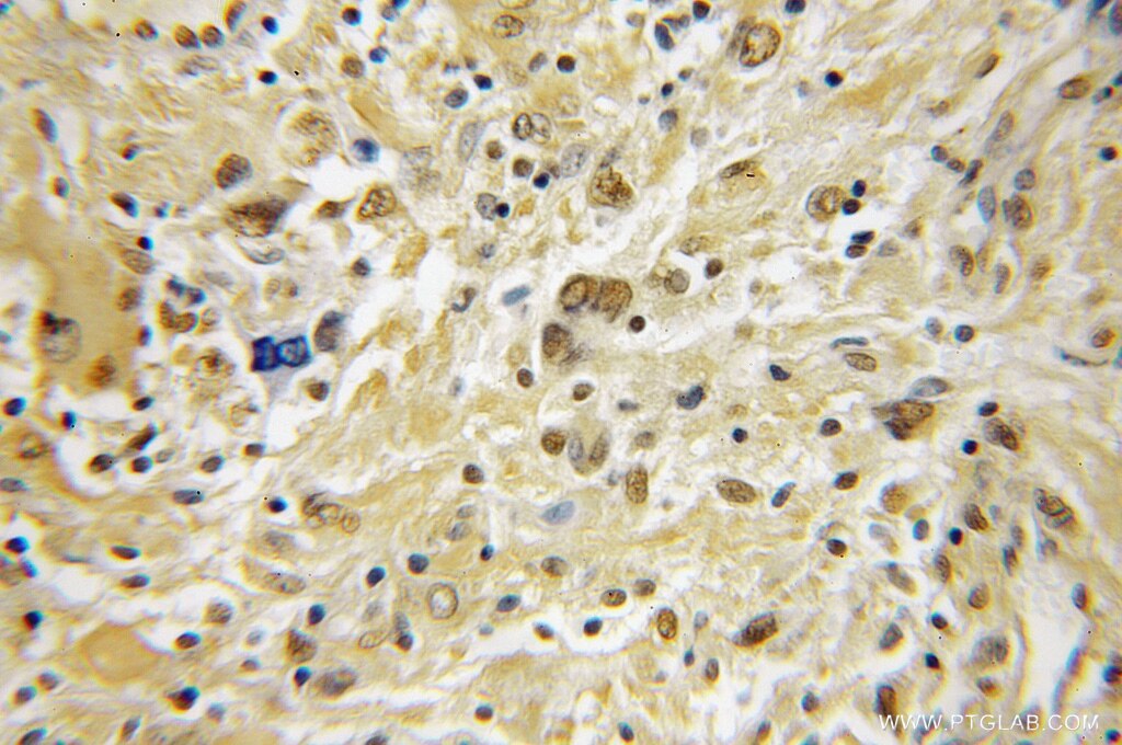 IHC staining of human medulloblastoma using 12232-1-AP