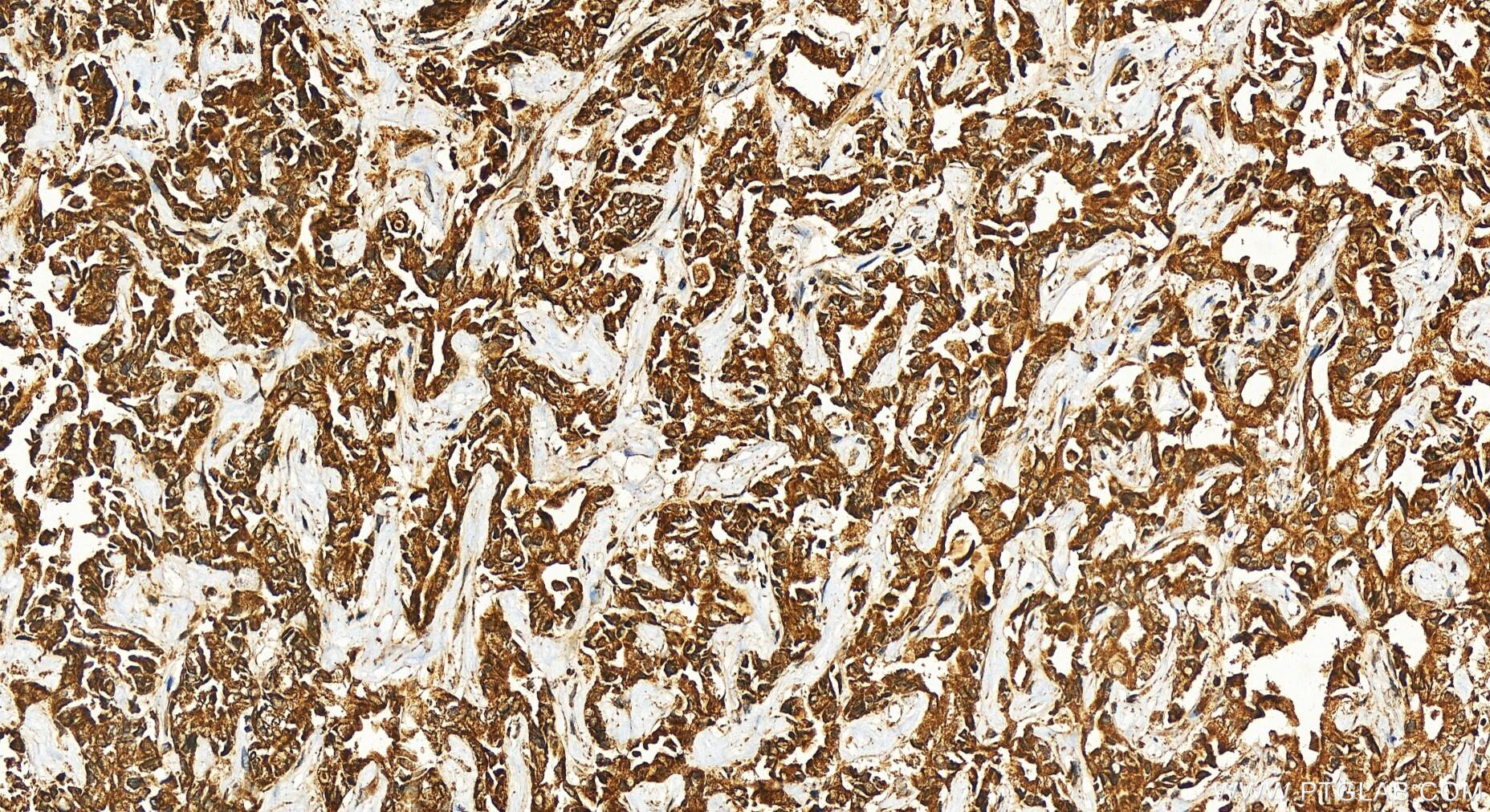 Immunohistochemistry (IHC) staining of human intrahepatic cholangiocarcinoma tissue using AMPK Gamma 2 Polyclonal antibody (12568-1-AP)