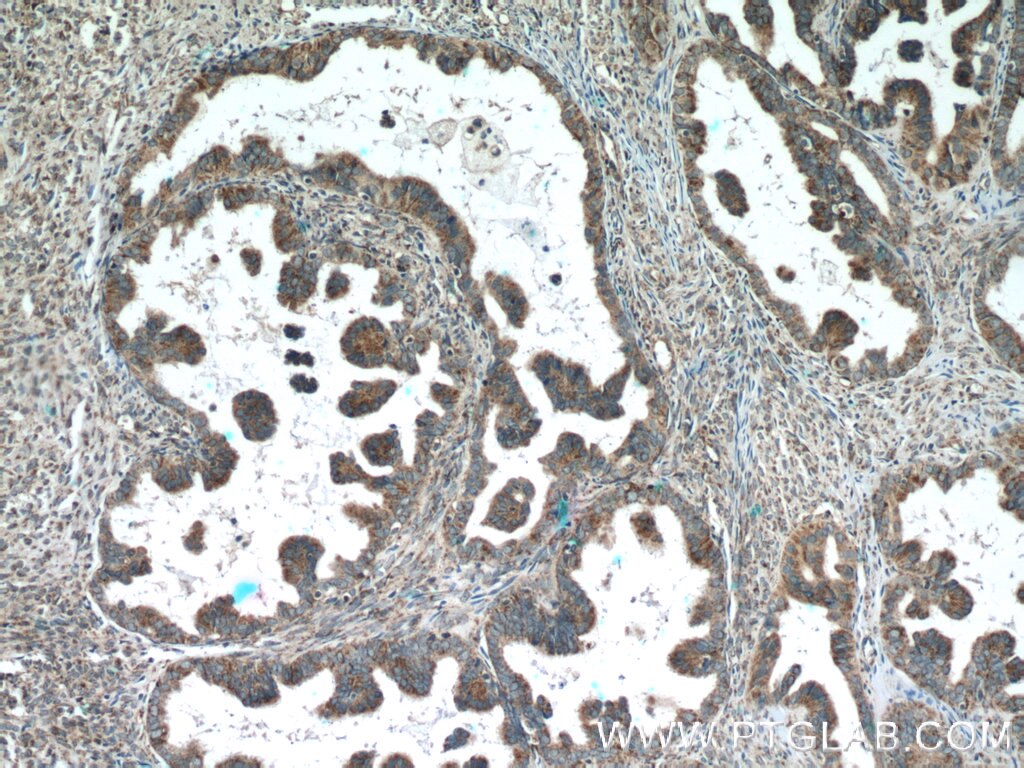 Immunohistochemistry (IHC) staining of human ovary tumor tissue using AMPK Gamma 2 Polyclonal antibody (12568-1-AP)