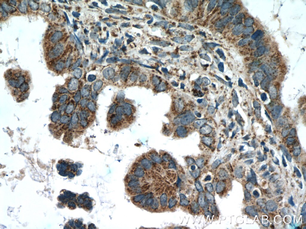 Immunohistochemistry (IHC) staining of human ovary tumor tissue using AMPK Gamma 2 Polyclonal antibody (12568-1-AP)