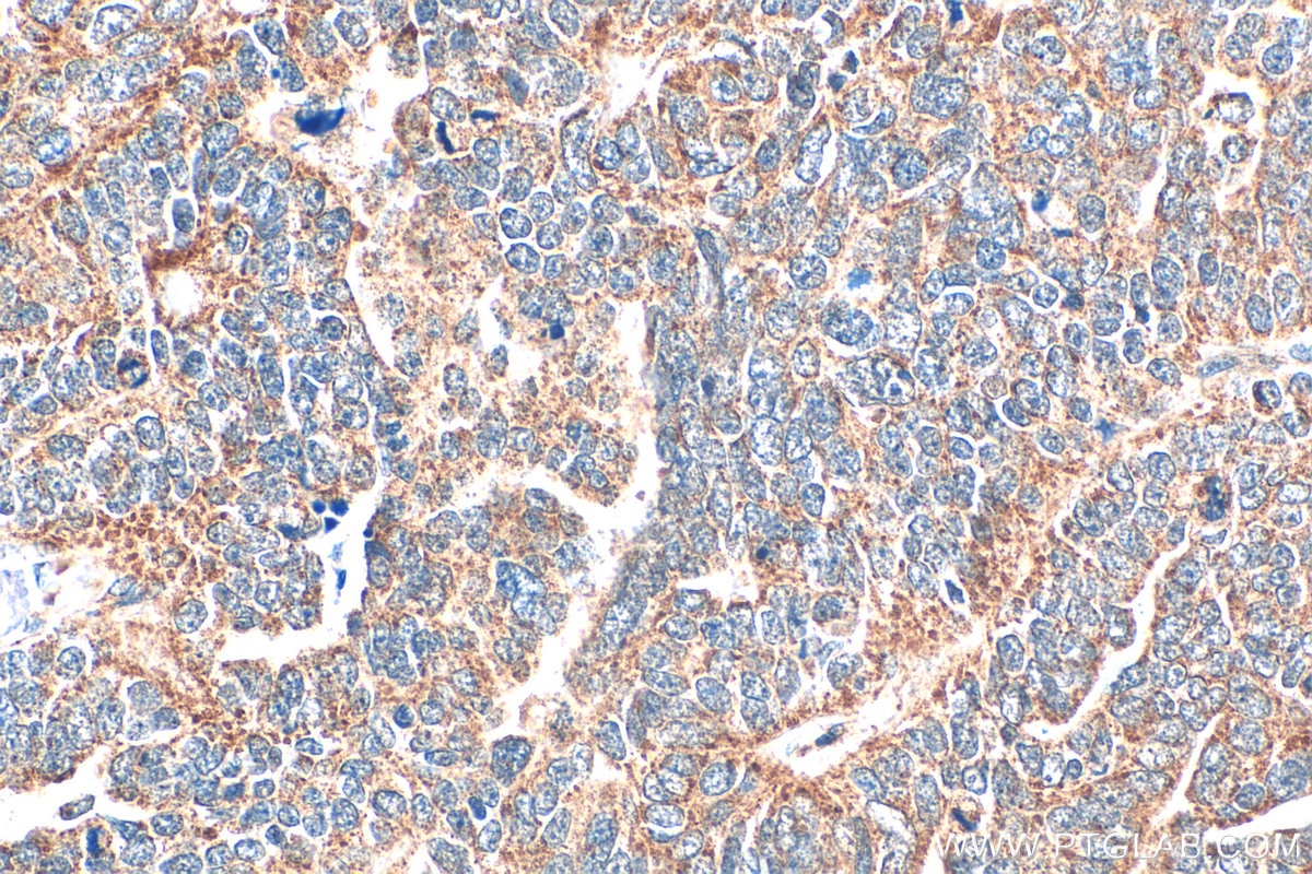 Immunohistochemistry (IHC) staining of human ovary tumor tissue using AMPK Gamma 2 Polyclonal antibody (12568-1-AP)