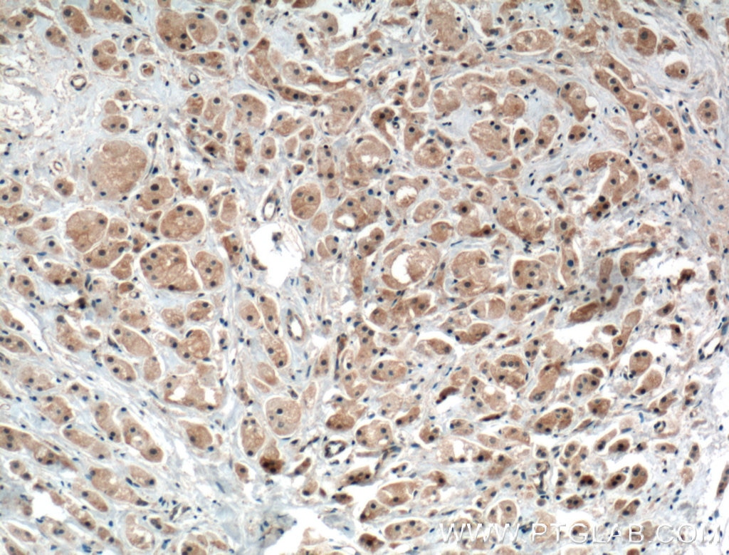 Immunohistochemistry (IHC) staining of human breast cancer tissue using PRKAR1B Polyclonal antibody (17991-1-AP)