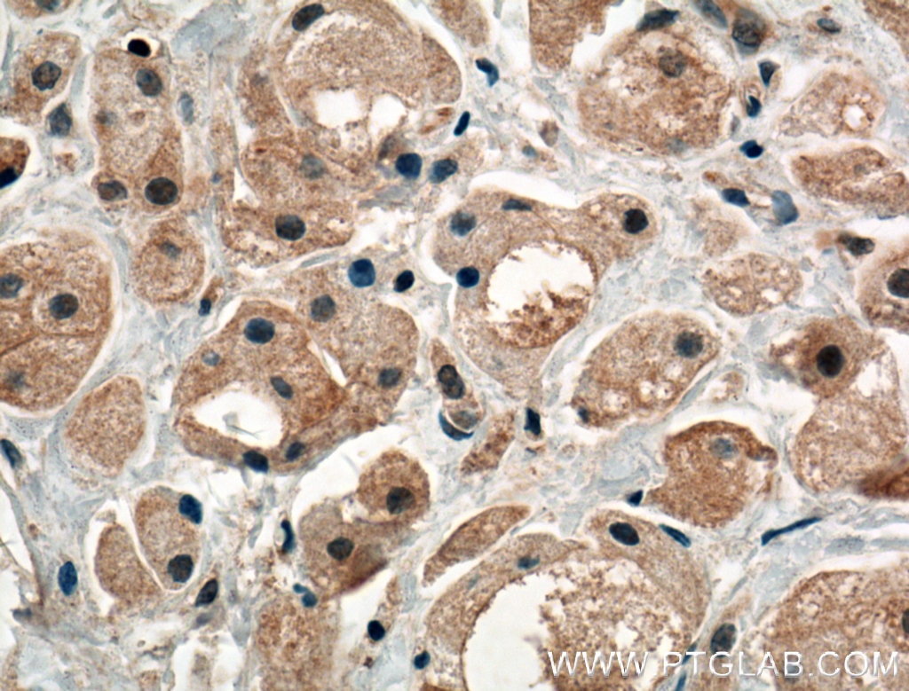 Immunohistochemistry (IHC) staining of human breast cancer tissue using PRKAR1B Polyclonal antibody (17991-1-AP)