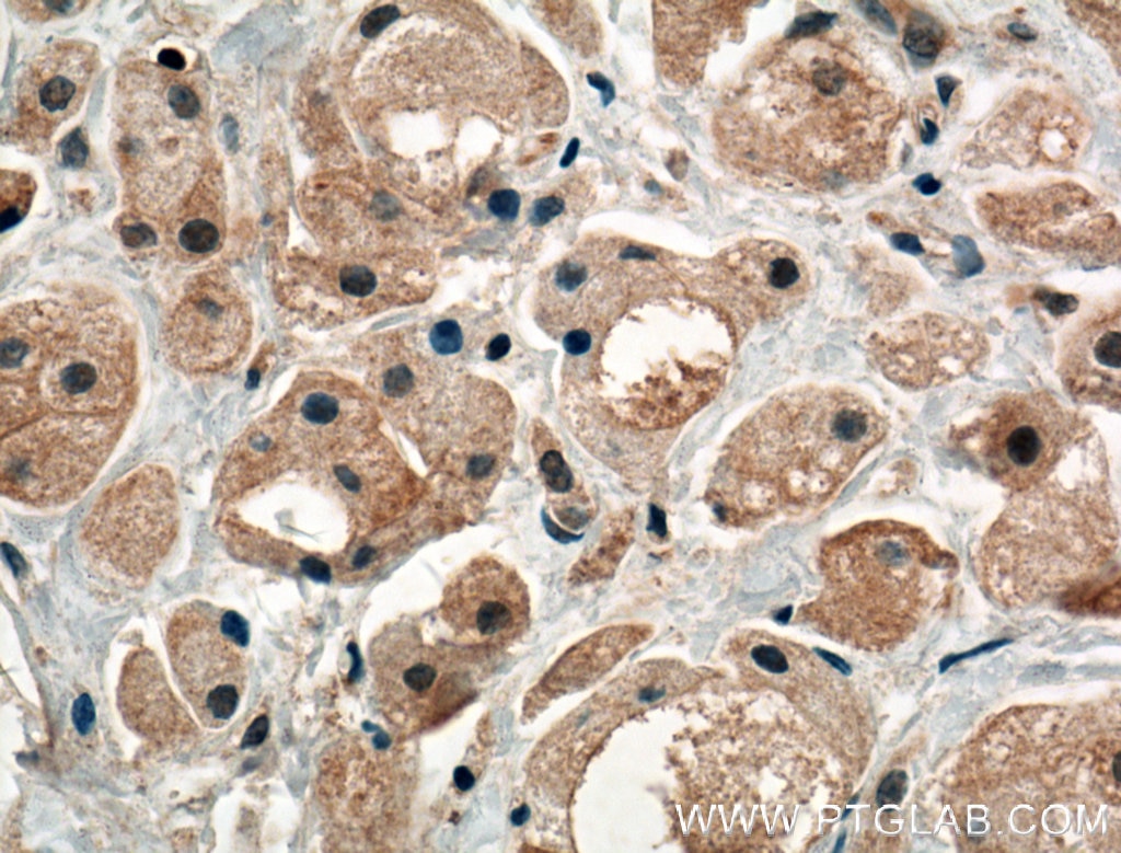 Immunohistochemistry (IHC) staining of human breast cancer tissue using PRKAR1B Polyclonal antibody (17991-1-AP)