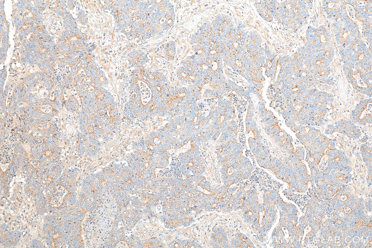 IHC staining of human colon cancer using 67751-1-Ig