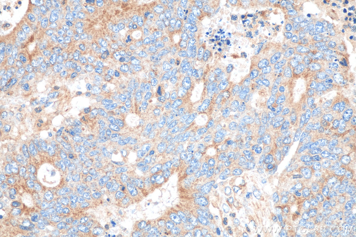 Immunohistochemistry (IHC) staining of human colon cancer tissue using PRKAR2A Monoclonal antibody (67751-1-Ig)