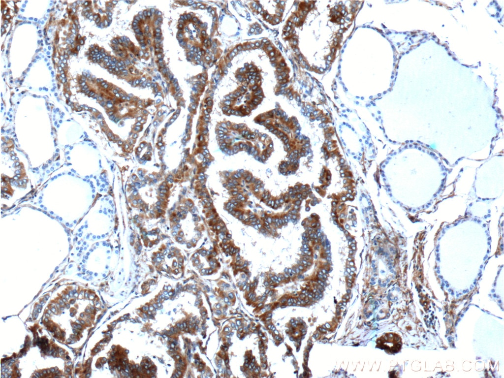 Immunohistochemistry (IHC) staining of human thyroid cancer tissue using PKC Alpha Polyclonal antibody (21991-1-AP)