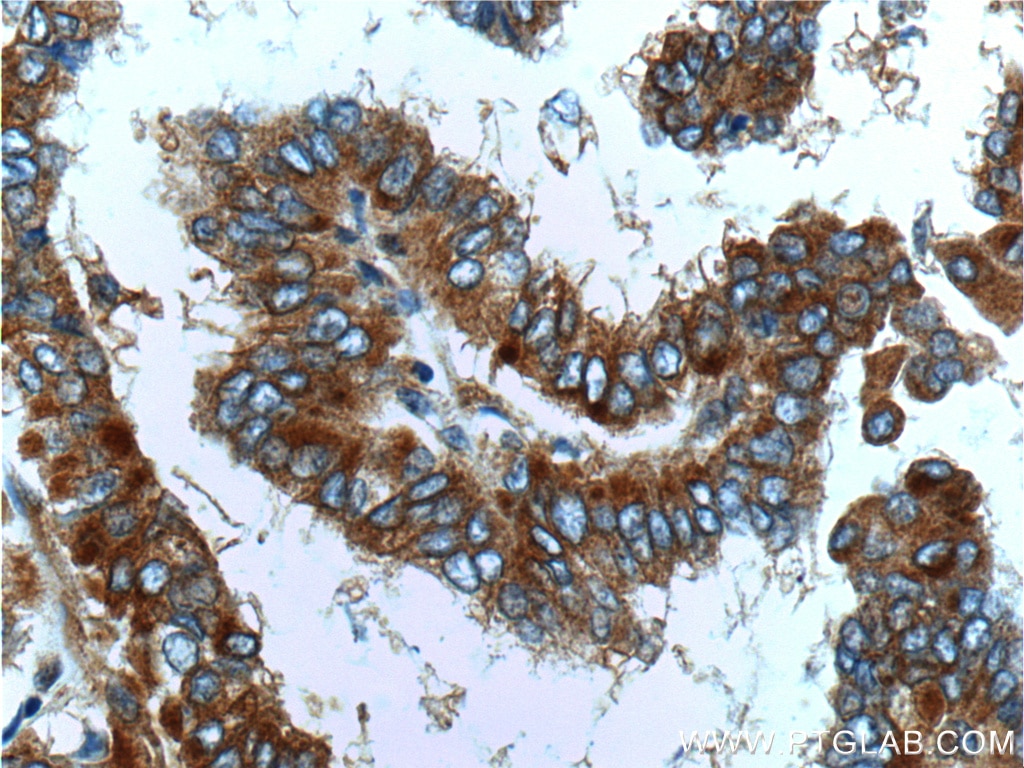 Immunohistochemistry (IHC) staining of human thyroid cancer tissue using PKC Alpha Polyclonal antibody (21991-1-AP)