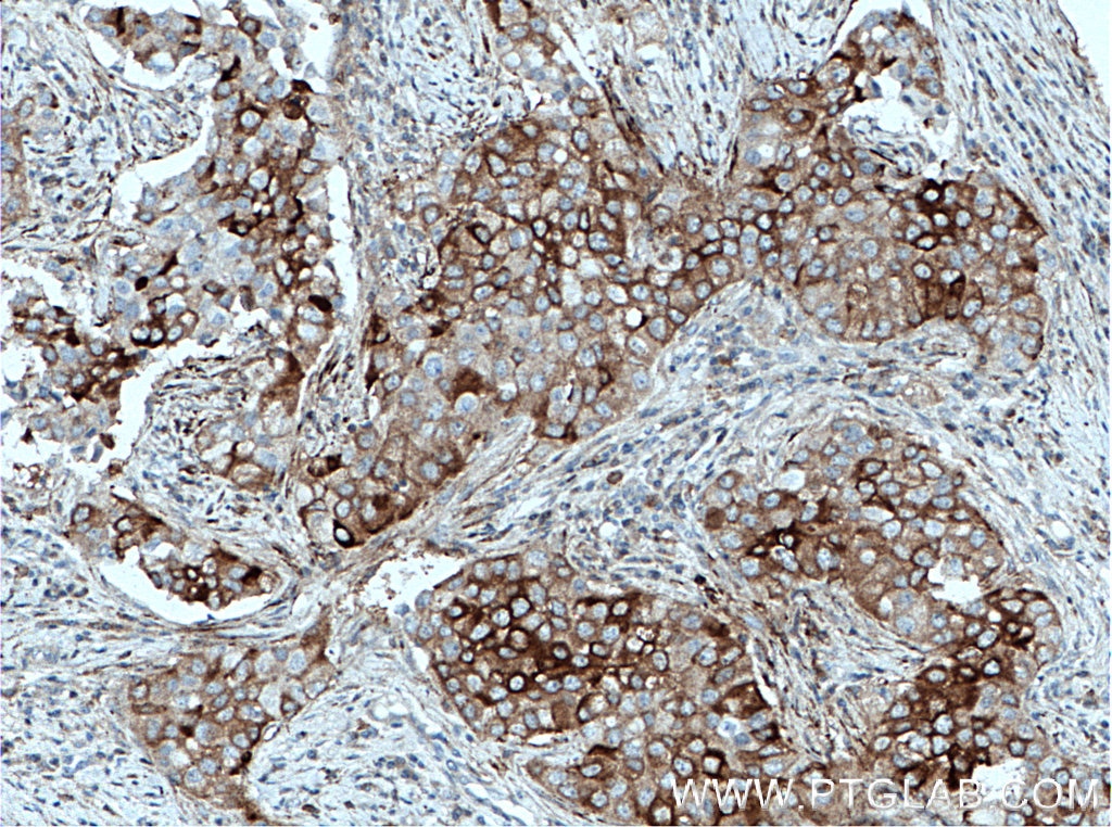 Immunohistochemistry (IHC) staining of human breast cancer tissue using PKC Beta Polyclonal antibody (12919-1-AP)