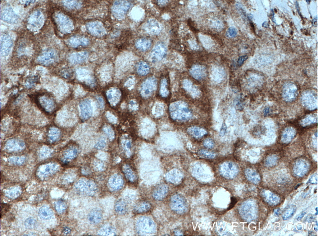 Immunohistochemistry (IHC) staining of human breast cancer tissue using pan-PKC Polyclonal antibody (12919-1-AP)