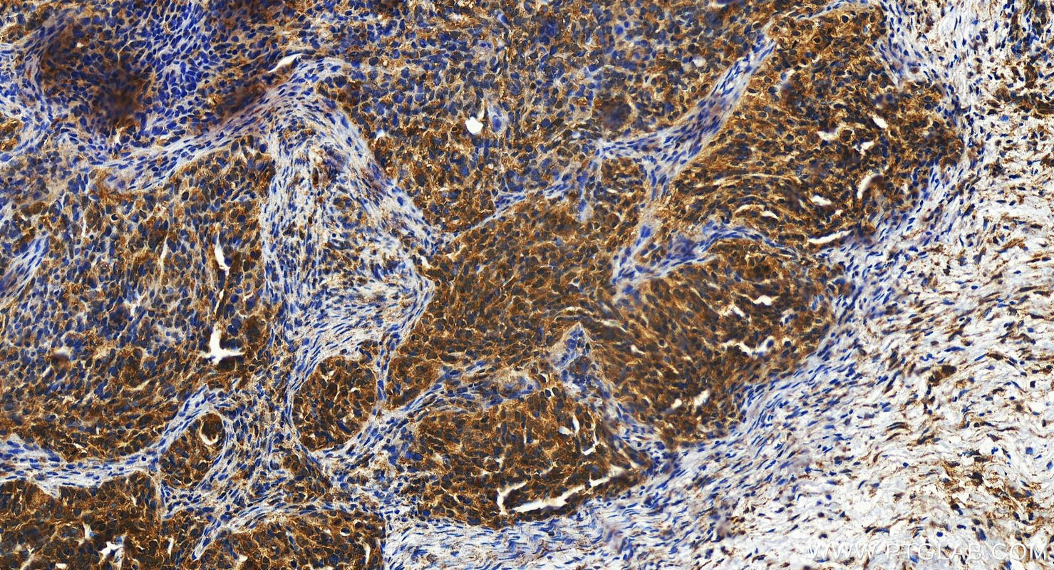 Immunohistochemistry (IHC) staining of human ovary cancer tissue using PKC Delta Polyclonal antibody (14188-1-AP)