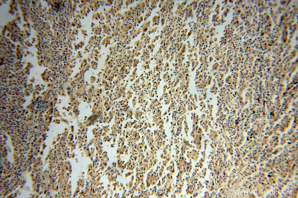Immunohistochemistry (IHC) staining of human lung cancer tissue using PRKCDBP Polyclonal antibody (16250-1-AP)