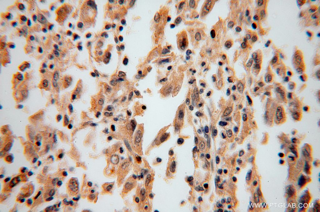 Immunohistochemistry (IHC) staining of human lung cancer tissue using PRKCDBP Polyclonal antibody (16250-1-AP)