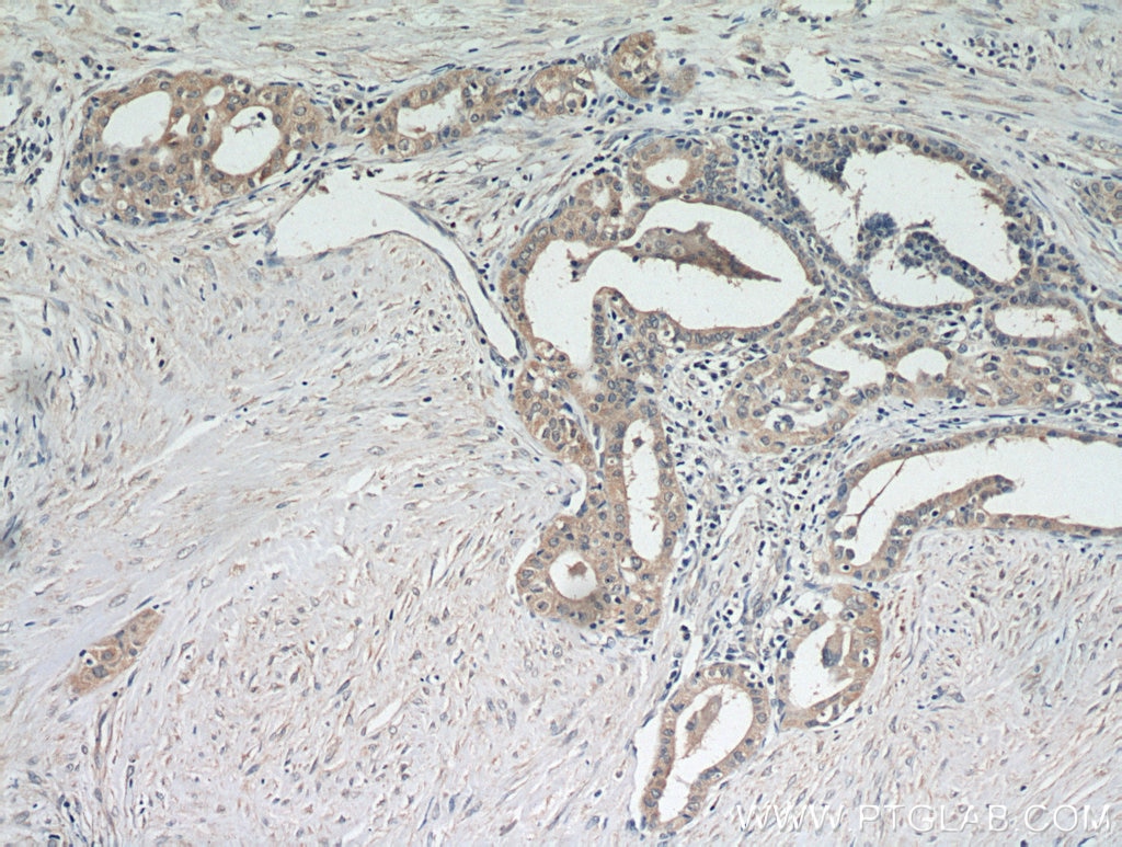 Immunohistochemistry (IHC) staining of human thyroid cancer tissue using PKC Epsilon Polyclonal antibody (20877-1-AP)