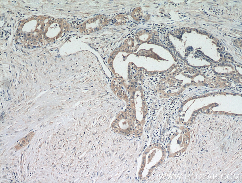 IHC staining of human thyroid cancer using 20877-1-AP