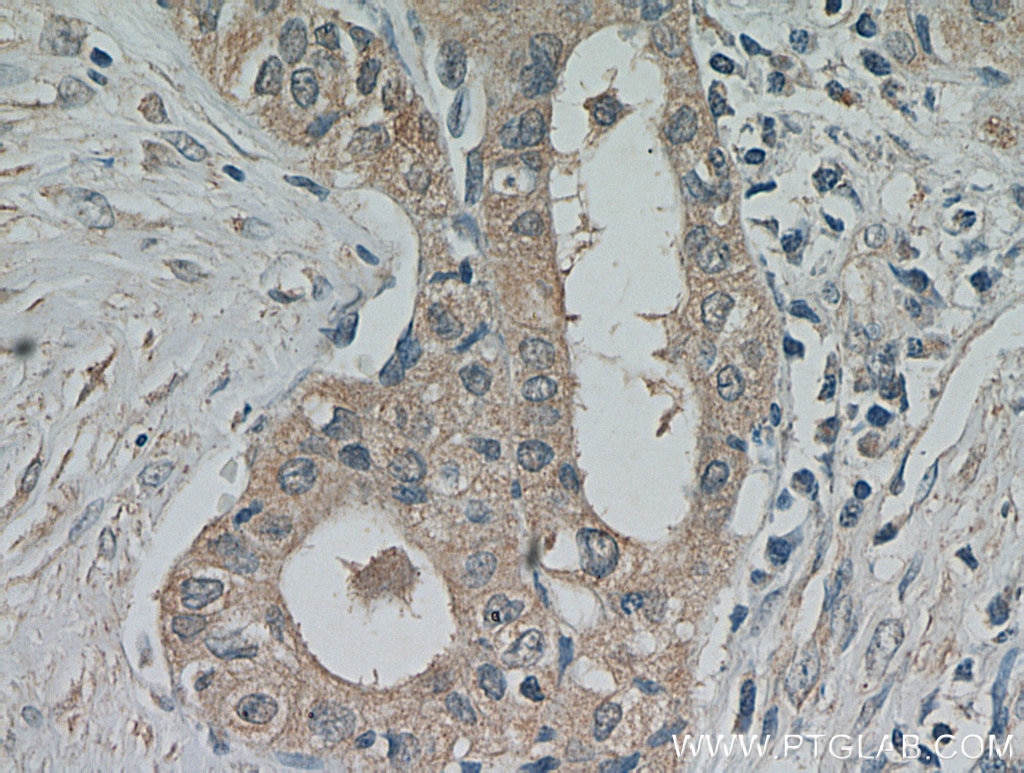 Immunohistochemistry (IHC) staining of human thyroid cancer tissue using PKC Epsilon Polyclonal antibody (20877-1-AP)