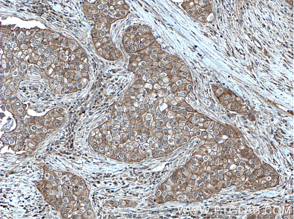 Immunohistochemistry (IHC) staining of human breast cancer tissue using PKC Iota Polyclonal antibody (13883-1-AP)