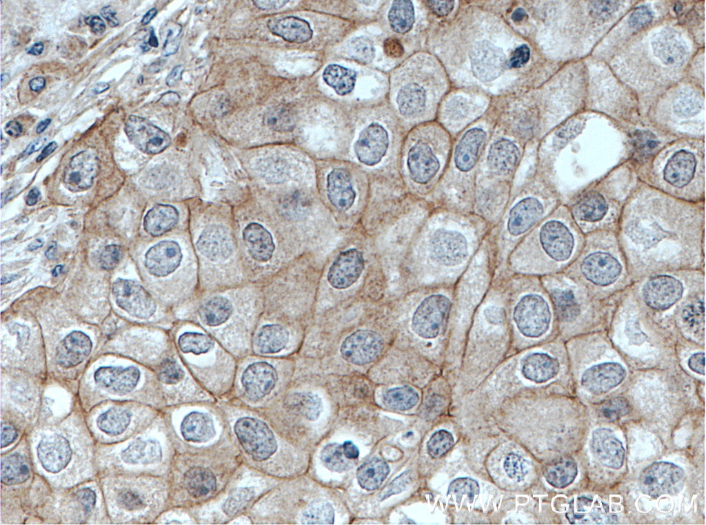 Immunohistochemistry (IHC) staining of human breast cancer tissue using PKC Iota Polyclonal antibody (13883-1-AP)