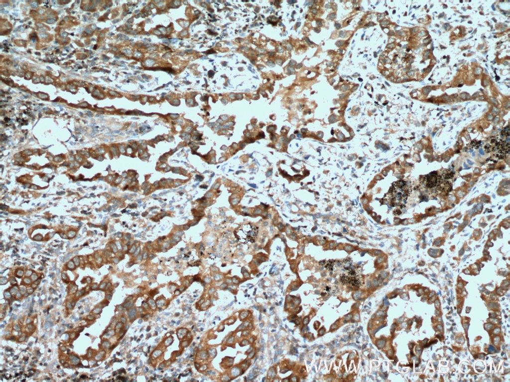 Immunohistochemistry (IHC) staining of human lung cancer tissue using PKC Iota Polyclonal antibody (13883-1-AP)