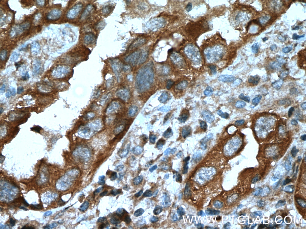 Immunohistochemistry (IHC) staining of human lung cancer tissue using PKC Iota Polyclonal antibody (13883-1-AP)