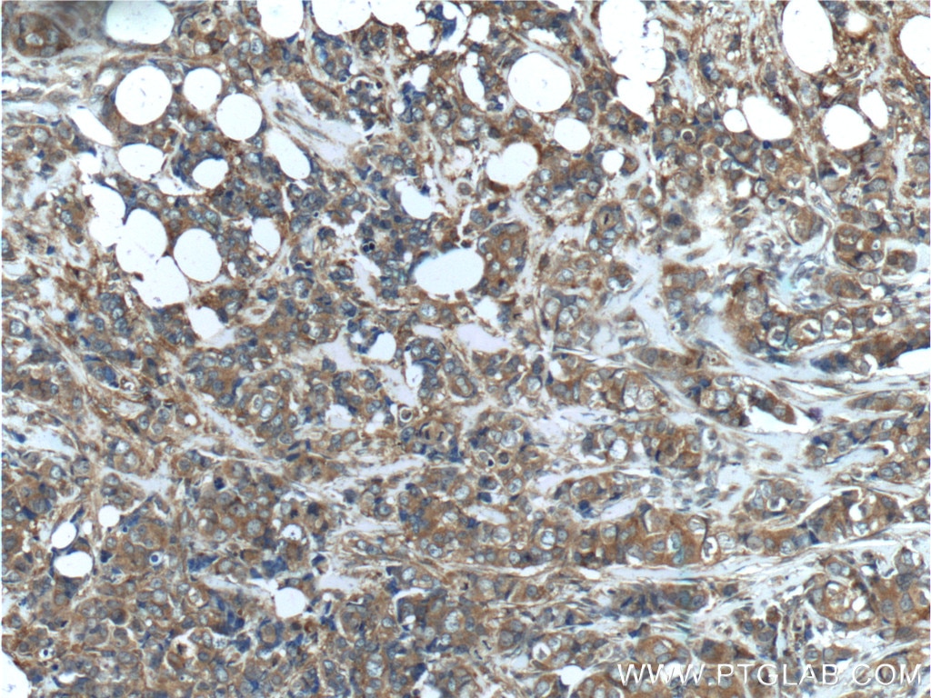 Immunohistochemistry (IHC) staining of human breast cancer tissue using PKC Zeta Polyclonal antibody (10860-1-AP)