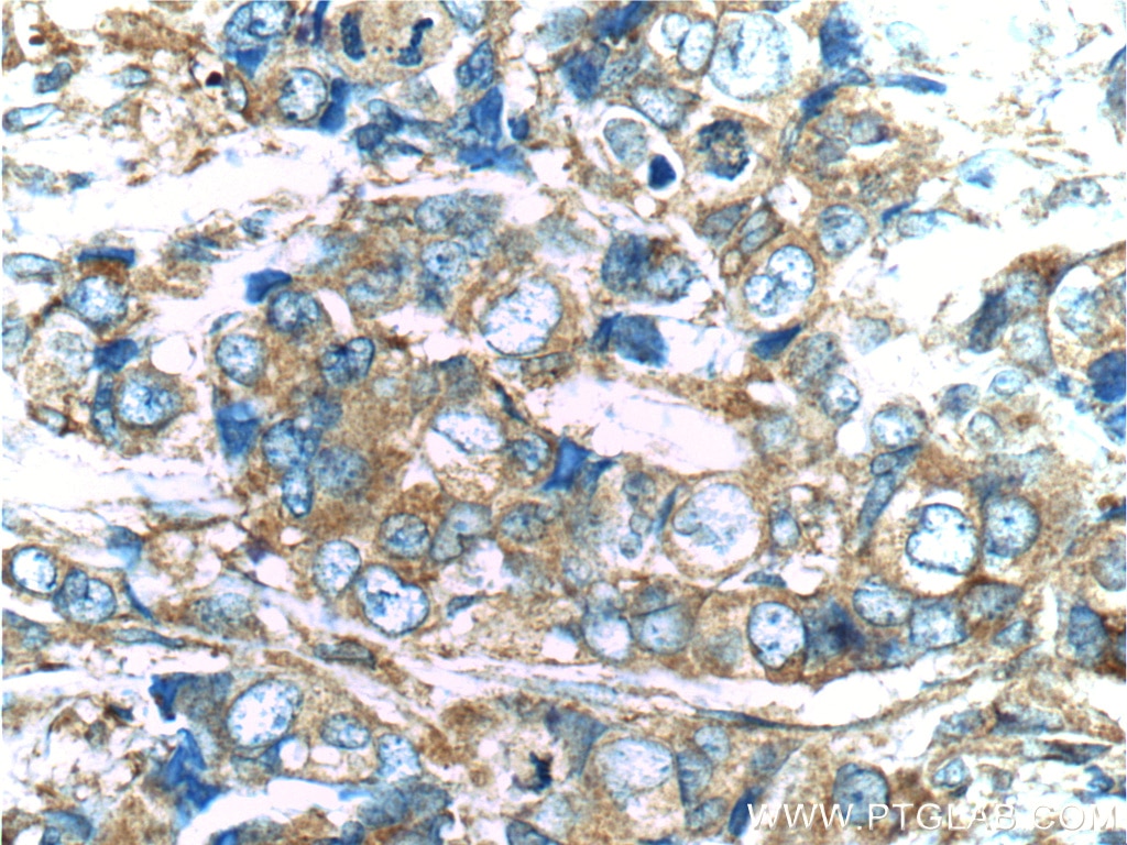 IHC staining of human breast cancer using 10860-1-AP
