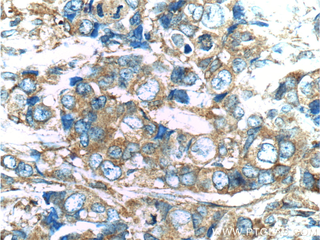 Immunohistochemistry (IHC) staining of human breast cancer tissue using PKC Zeta Polyclonal antibody (10860-1-AP)