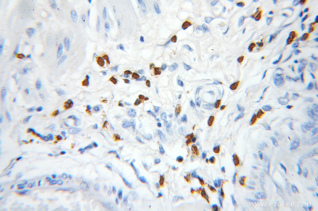 Immunohistochemistry (IHC) staining of human colon cancer tissue using PRKD2 Polyclonal antibody (11623-1-AP)